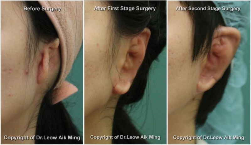 Reconstructed Ear From Rib Ear Reconstruction - Elegant Plastic Surgical Centre in Ipoh & Manjung ...