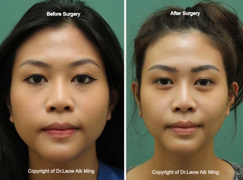 Mandibular Angle Reduction Surgery Elegant Plastic Surgical Centre in