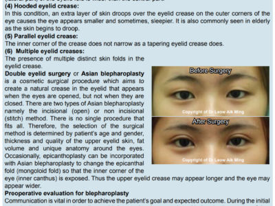 2. Double Eyelid Surgery (Asian Blepharoplasty)