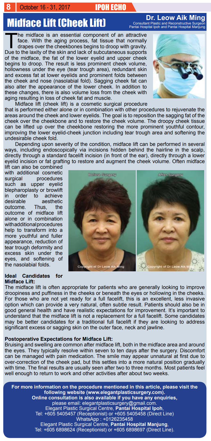 Midface Lift Cheek Lift Elegant Plastic Surgical Centre In Ipoh Manjung Malaysia