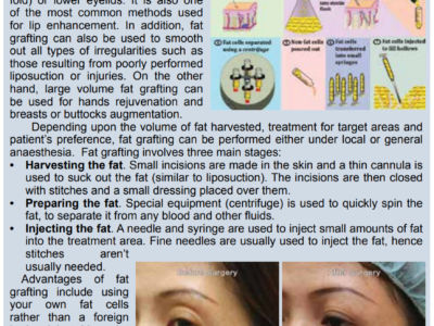 Fat Grafting Lipofilling