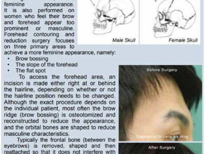 9. Forehead Contouring Surgery (Feminization Surgery)