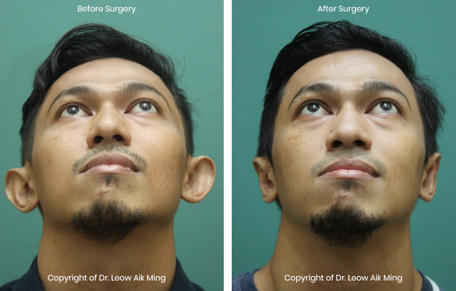 otoplasty surgery